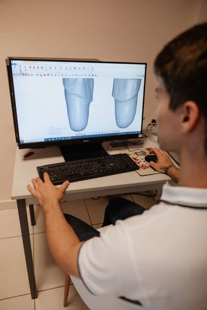 Technicien utilisant le logiciel Rodin 4D pour modifier la modélisation 3D d'une emboîture de prothèse fémorale sur un écran iiyama.